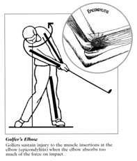 Golfer Elbow Image
